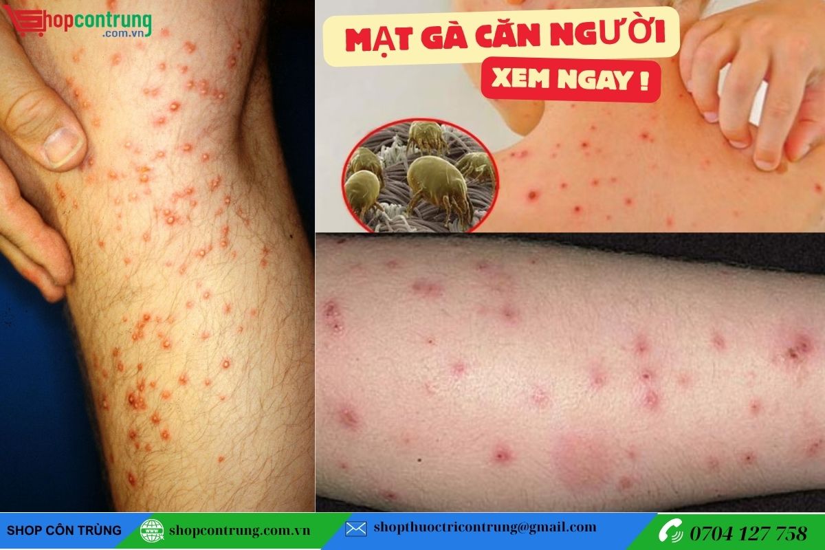 DẤU HIỆU MẠT GÀ CẮN NGƯỜI